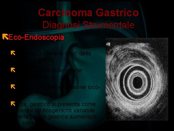 Carcinoma Gastrico Diagnosi Strumentale ëEco-Endoscopia ëVisualizza i diversi strati della parete gastrica ëEvidenzia linfoadenopatie