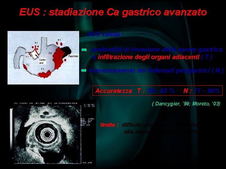 EUS : stadiazione Ca gastrico avanzato EUS valuta : profondità di invasione della parete
