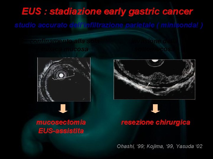 EUS : stadiazione early gastric cancer studio accurato dell’infiltrazione parietale ( minisonda! ) confinamento