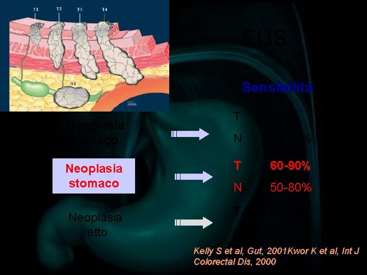 EUS Sensibilità T 85% N 50 -90% Neoplasia stomaco T 60 -90% N 50
