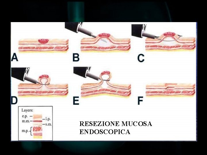 RESEZIONE MUCOSA ENDOSCOPICA 