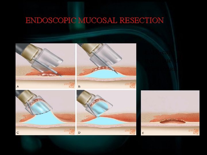 ENDOSCOPIC MUCOSAL RESECTION EMR-cap technique after submucosal lifting 