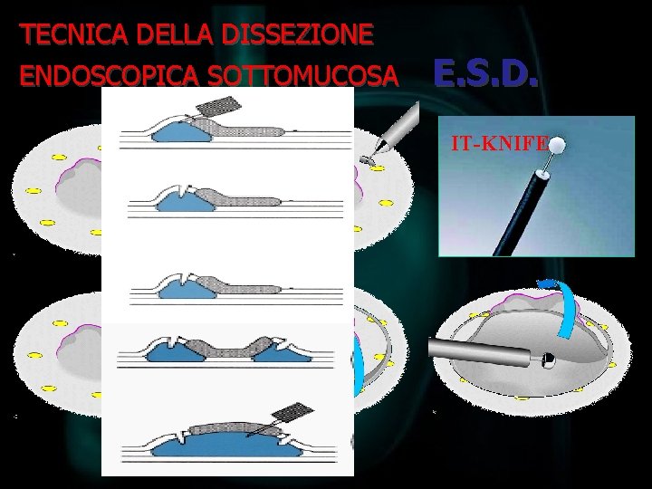 TECNICA DELLA DISSEZIONE ENDOSCOPICA SOTTOMUCOSA E. S. D. IT-KNIFE 