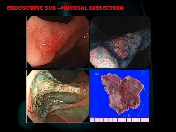 ENDOSCOPIC SUB –MUCOSAL DISSECTION 