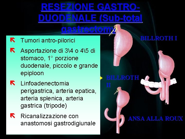 RESEZIONE GASTRODUODENALE (Sub-total gastrectomy) BILLROTH I ë Tumori antro-pilorici ë Asportazione di 34 o