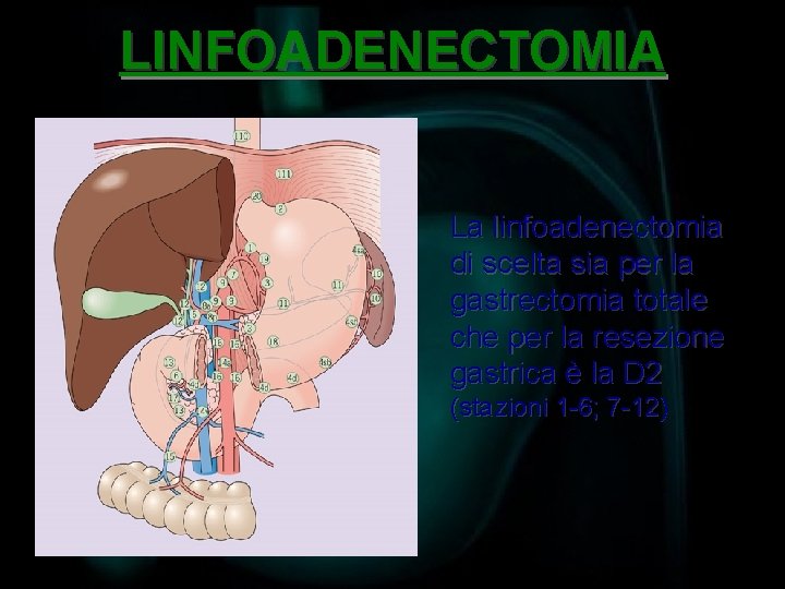 LINFOADENECTOMIA La linfoadenectomia di scelta sia per la gastrectomia totale che per la resezione