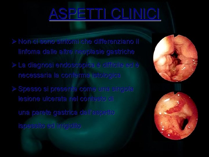 ASPETTI CLINICI Ø Non ci sono sintomi che differenziano il linfoma dalle altre neoplasie