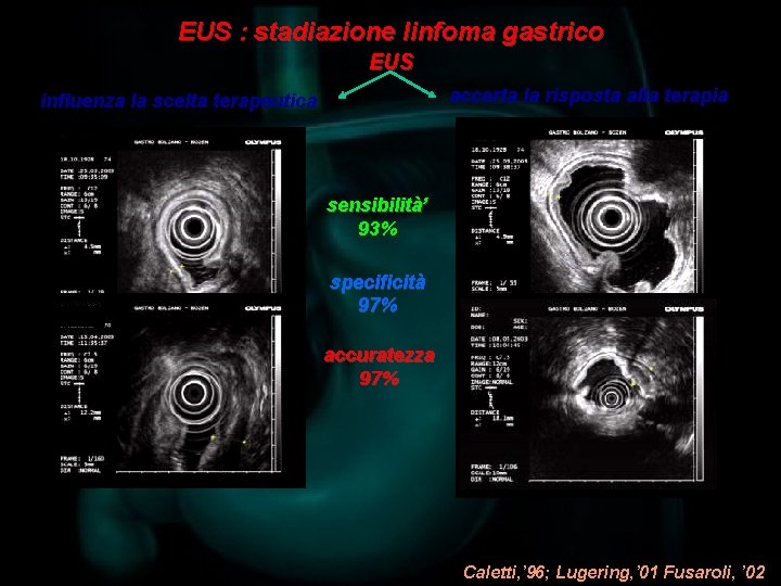EUS : stadiazione linfoma gastrico EUS accerta la risposta alla terapia influenza la scelta