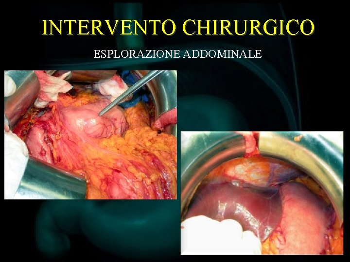 INTERVENTO CHIRURGICO ESPLORAZIONE ADDOMINALE 