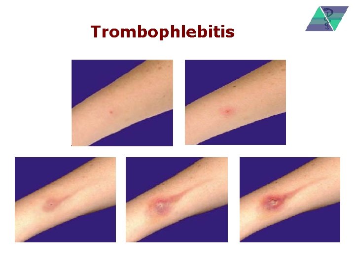 Trombophlebitis 