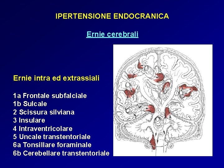 IPERTENSIONE ENDOCRANICA Ernie cerebrali Ernie intra ed extrassiali 1 a Frontale subfalciale 1 b IPERTENSIONE ENDOCRANICA Ernie cerebrali Ernie intra ed extrassiali 1 a Frontale subfalciale 1 b
