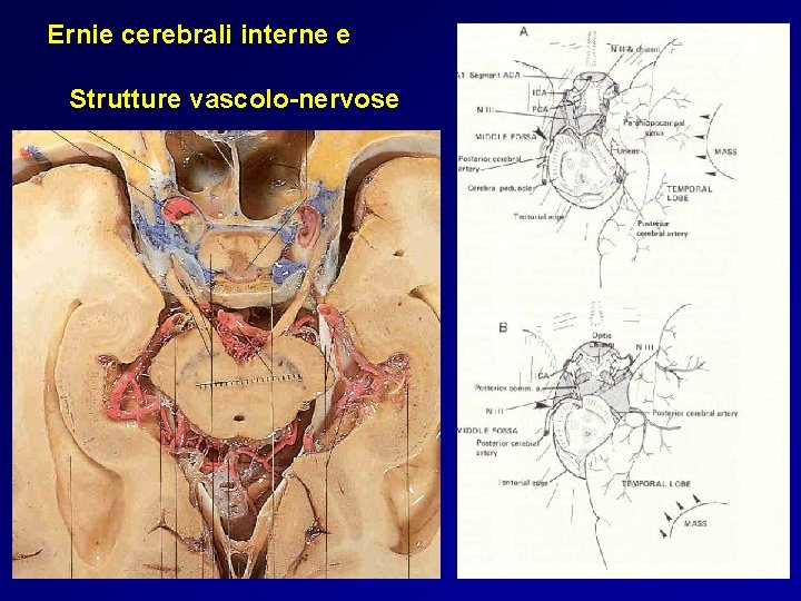 Ernie cerebrali interne e Strutture vascolo-nervose Ernie cerebrali interne e Strutture vascolo-nervose