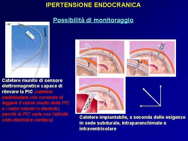 IPERTENSIONE ENDOCRANICA Possibilità di monitoraggio Catetere munito di sensore elettromagnetico capace di rilevare la IPERTENSIONE ENDOCRANICA Possibilità di monitoraggio Catetere munito di sensore elettromagnetico capace di rilevare la