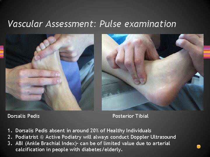 Vascular Assessment: Pulse examination Dorsalis Pedis Posterior Tibial 1. Dorsalis Pedis absent in around