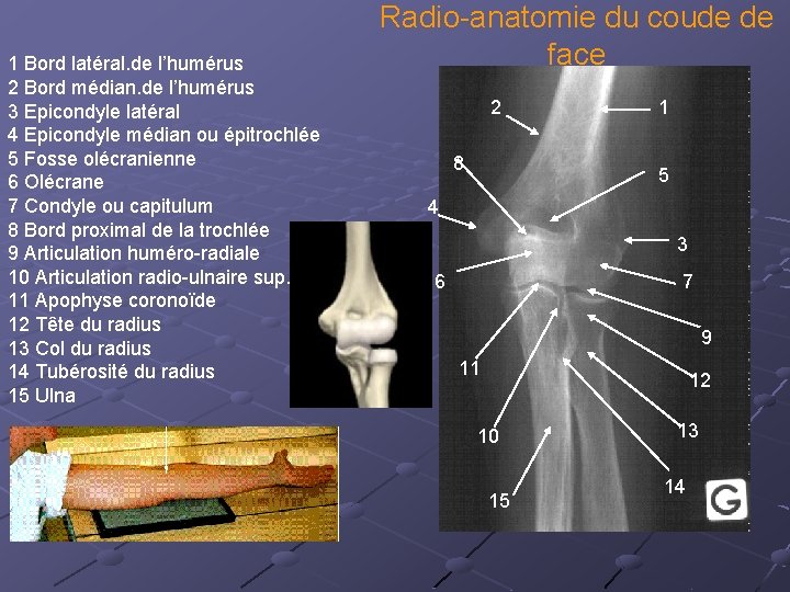 1 Bord latéral. de l’humérus 2 Bord médian. de l’humérus 3 Epicondyle latéral 4