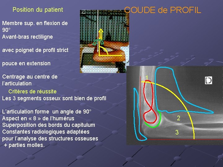 Position du patient COUDE de PROFIL Membre sup. en flexion de 90° Avant-bras rectiligne