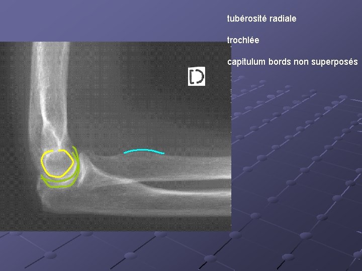  tubérosité radiale trochlée capitulum bords non superposés 