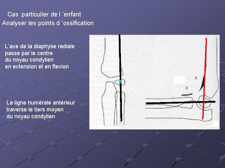  Cas particulier de l ’enfant Analyser les points d ’ossification L’axe de la