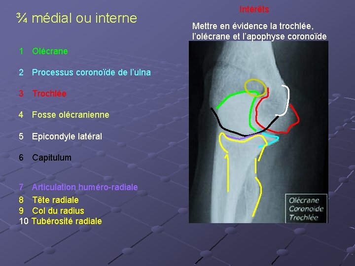 Intérêts ¾ médial ou interne Mettre en évidence la trochlée, l’olécrane et l’apophyse coronoïde