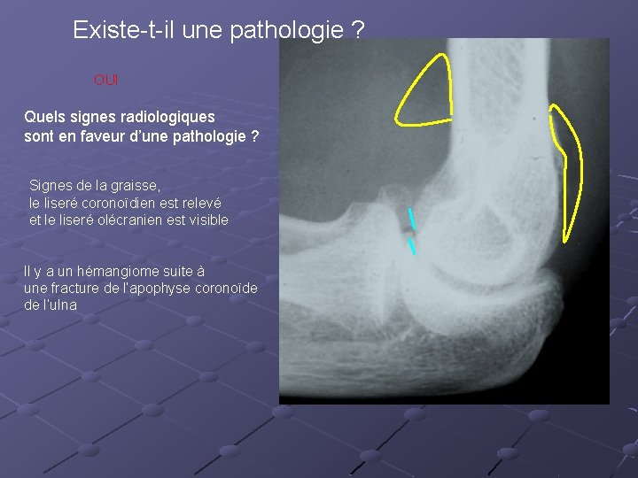 Existe-t-il une pathologie ? OUI Quels signes radiologiques sont en faveur d’une pathologie ?