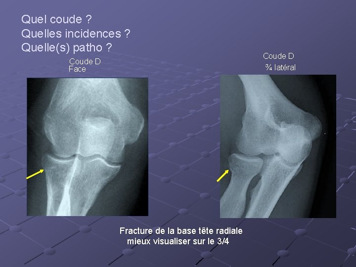 Quel coude ? Quelles incidences ? Quelle(s) patho ? Coude D Face Fracture de