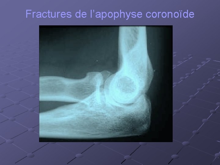 Fractures de l’apophyse coronoïde 
