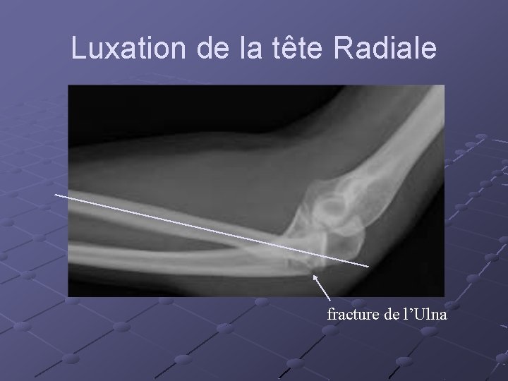 Luxation de la tête Radiale fracture de l’Ulna 