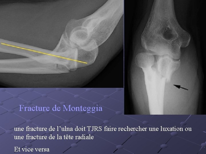 Fracture de Monteggia une fracture de l’ulna doit TJRS faire recher une luxation ou