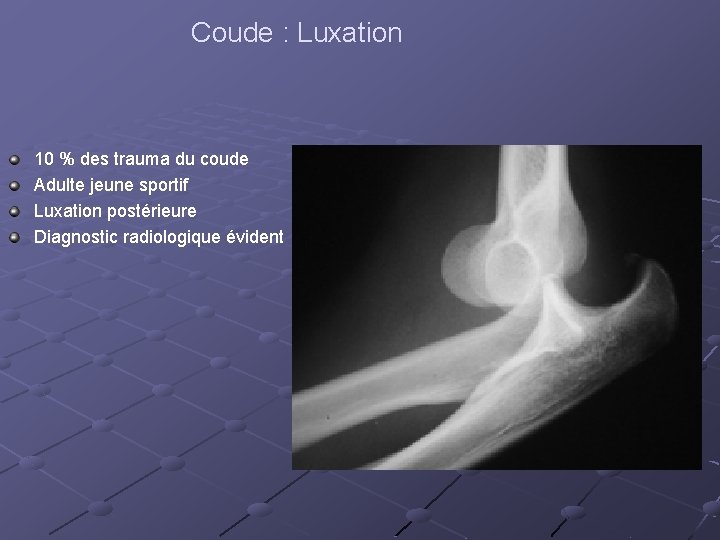 Coude : Luxation 10 % des trauma du coude Adulte jeune sportif Luxation postérieure