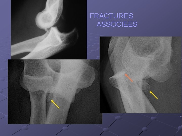 FRACTURES ASSOCIEES 