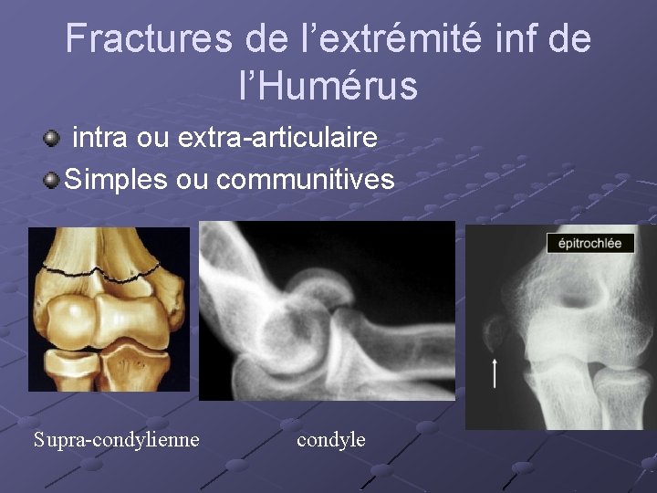 Fractures de l’extrémité inf de l’Humérus intra ou extra-articulaire Simples ou communitives Supra-condylienne condyle