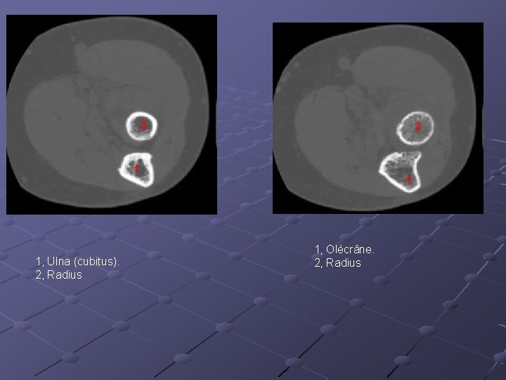 1, Ulna (cubitus). 2, Radius 1, Olécrâne. 2, Radius 