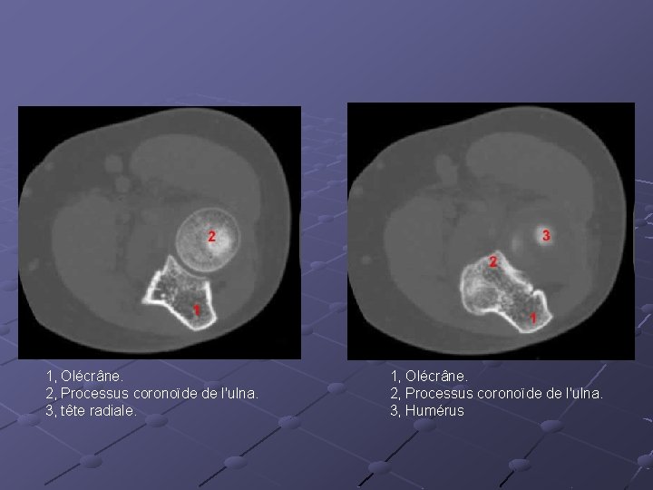 1, Olécrâne. 2, Processus coronoïde de l'ulna. 3, tête radiale. 1, Olécrâne. 2, Processus