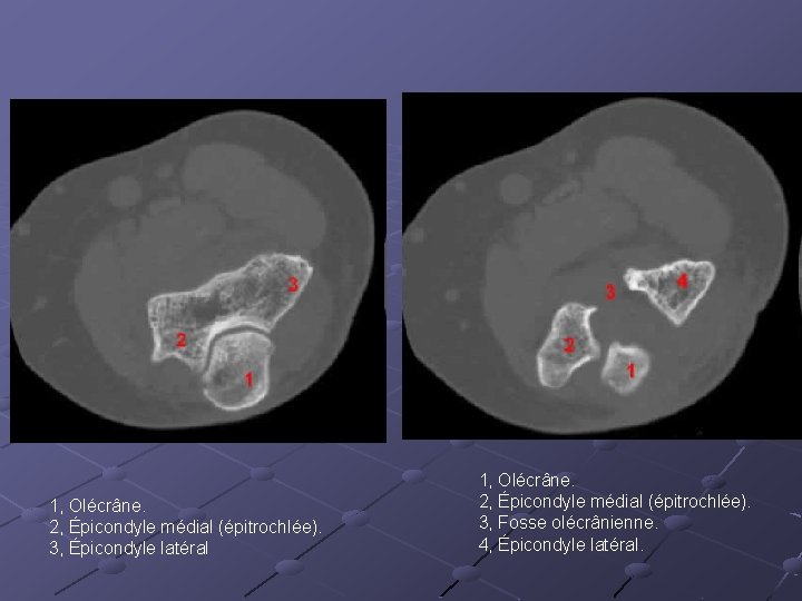 1, Olécrâne. 2, Épicondyle médial (épitrochlée). 3, Épicondyle latéral 1, Olécrâne. 2, Épicondyle médial