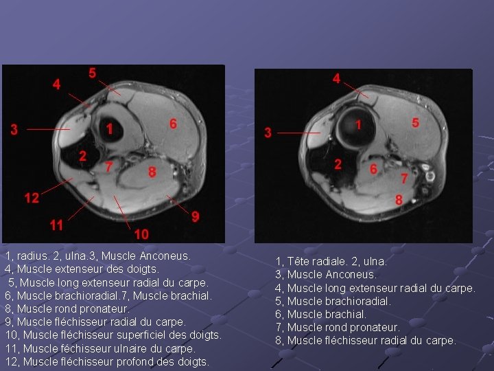 1, radius. 2, ulna. 3, Muscle Anconeus. 4, Muscle extenseur des doigts. 5, Muscle