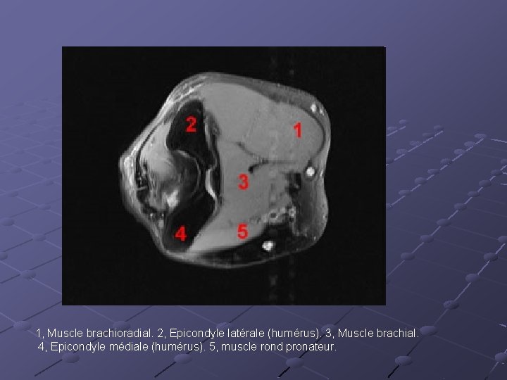 1, Muscle brachioradial. 2, Epicondyle latérale (humérus). 3, Muscle brachial. 4, Epicondyle médiale (humérus).