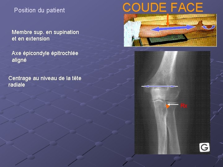 Position du patient COUDE FACE Membre sup. en supination et en extension Axe épicondyle