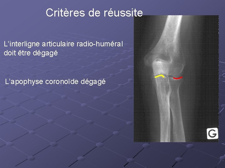 Critères de réussite L’interligne articulaire radio-huméral doit être dégagé L’apophyse coronoïde dégagé 