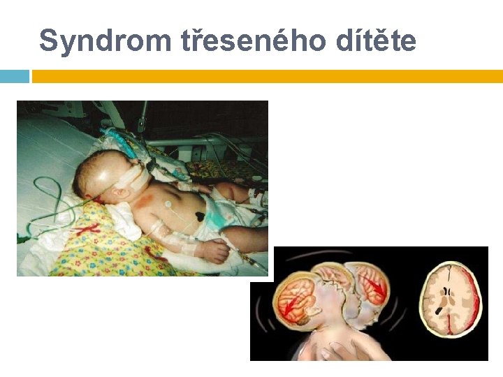 Syndrom třeseného dítěte Syndrom třeseného dítěte