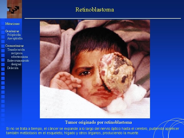 Retinoblastoma Mutaciones Genómicas Poliploidía Aneuploidía Cromosómicas Translocación recíproca robertsoniana Entrecruzamiento desigual Deleción Tumor originado