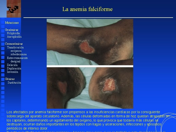 La anemia falciforme Mutaciones Genómicas Poliploidía Aneuploidía Cromosómicas Translocación recíproca robertsoniana Entrecruzamiento desigual Deleción