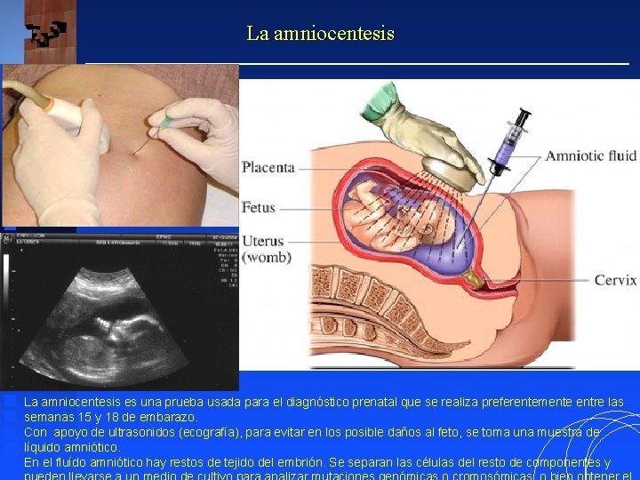 La amniocentesis es una prueba usada para el diagnóstico prenatal que se realiza preferentemente