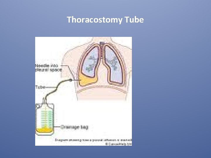 Thoracostomy Tube 