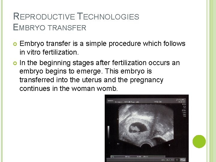 REPRODUCTIVE TECHNOLOGIES EMBRYO TRANSFER Embryo transfer is a simple procedure which follows in vitro