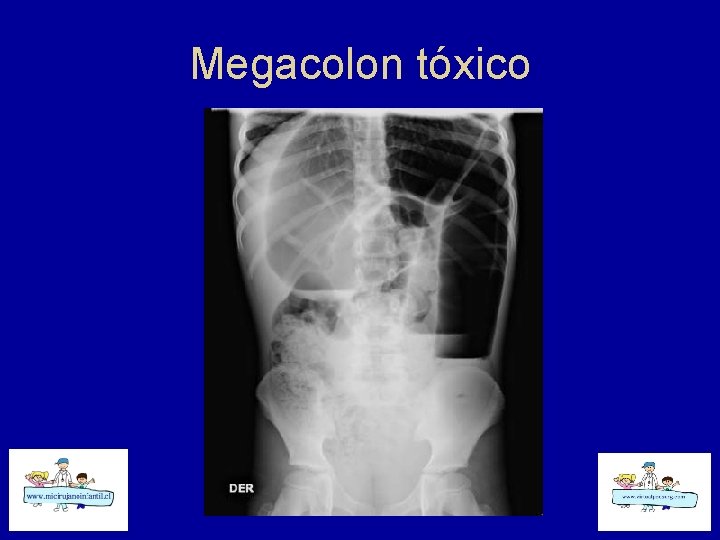 Megacolon tóxico 
