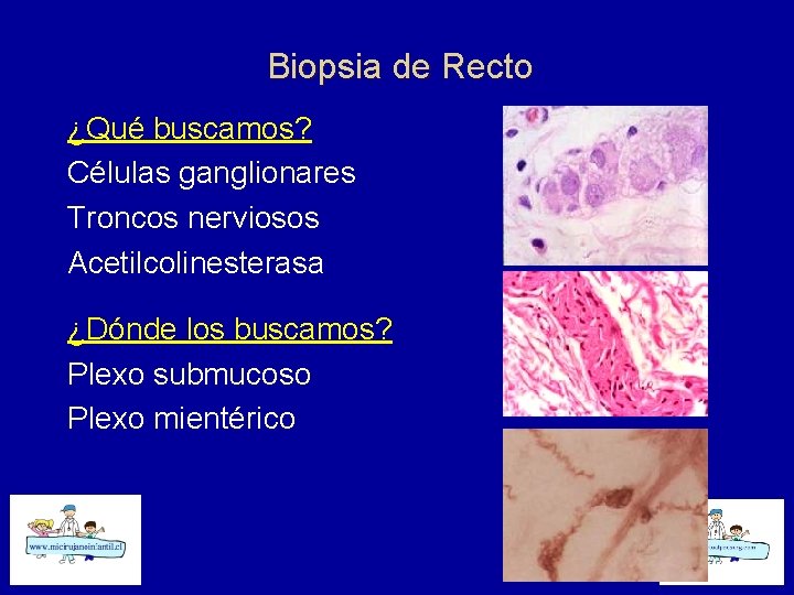 Biopsia de Recto ¿Qué buscamos? Células ganglionares Troncos nerviosos Acetilcolinesterasa ¿Dónde los buscamos? Plexo