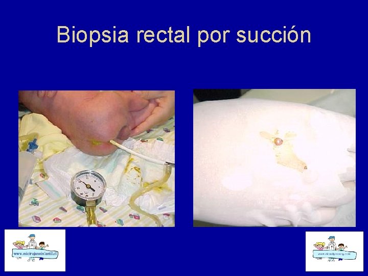 Biopsia rectal por succión 