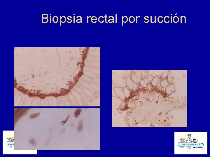 Biopsia rectal por succión 