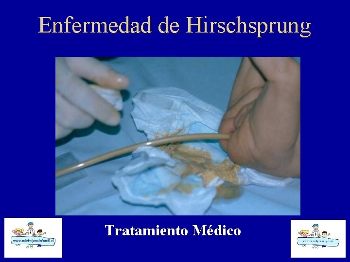Enfermedad de Hirschsprung Tratamiento Médico 