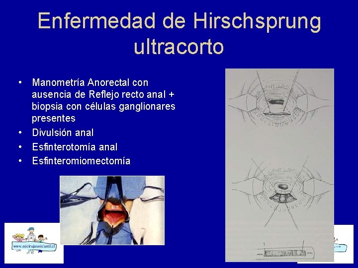 Enfermedad de Hirschsprung ultracorto • Manometría Anorectal con ausencia de Reflejo recto anal +
